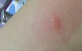 被蚊子咬了怎么处理,可以用盐水直接涂抹在叮咬部位