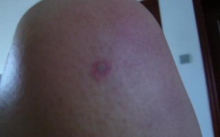 被马蜂蛰后过多久才脱离危险，24小时内无异常即可逐渐恢复