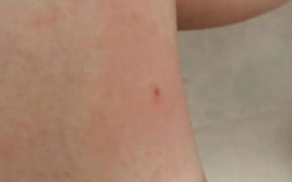 被马蜂蛰后过多久才脱离危险，24小时内无异常即可逐渐恢复