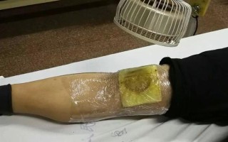 被黄胡蜂蛰了怎么办，远离蜂巢后再用弱酸性溶液清洗伤处